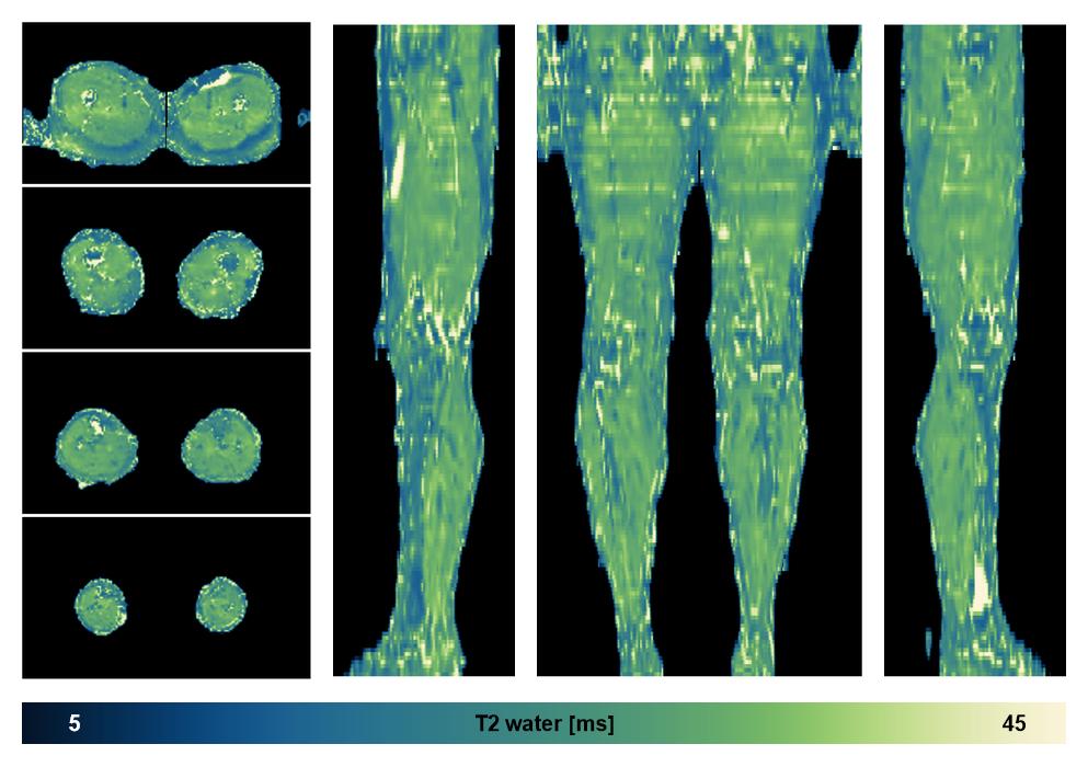 The water only T2 relaxation time of the lower extremity obtained from multi echo spin echo t2 mapping with EPG based reconstruction.